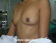 plastic-surgery-breast-augmentation 